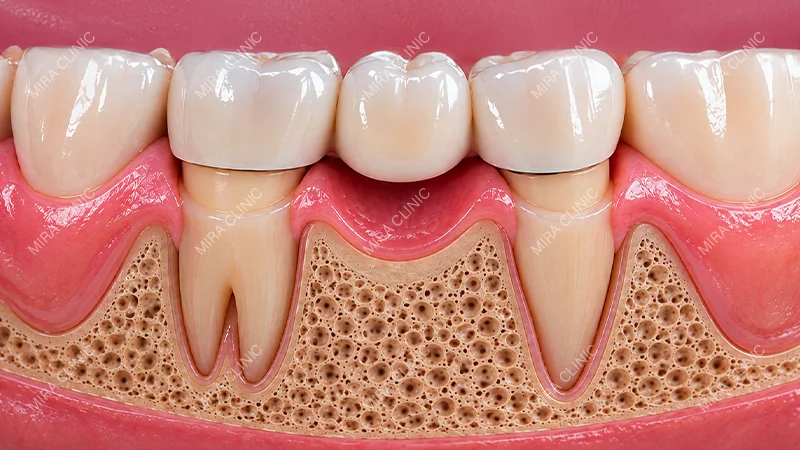 Dental Bridge